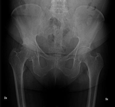  Radiografia bacino pre-operatorio