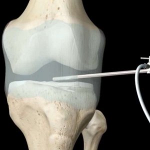 Artroscopia ginocchio