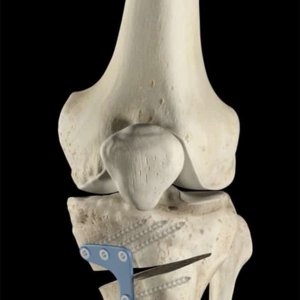 Osteotomia tibiale correzione asse