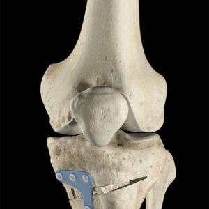 Osteotomia tibiale correzione innesto osseo