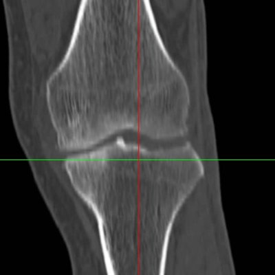  Pianificazione protesi di ginocchio