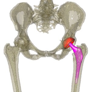 Pianificazione protesi d'anca