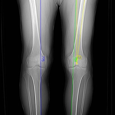  Pianificazione protesi di ginocchio