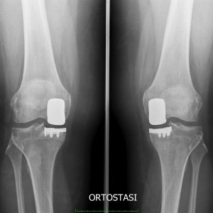 Protesi bilaterale di ginocchio monocompartimentalee