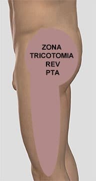 Tricotomia per revisione di protesi totale di anca